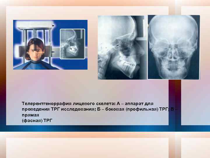 Телерентгеноррафия лицевого скелета: А – аппарат для проведения ТРГ исследования; Б – боковая (профильная)