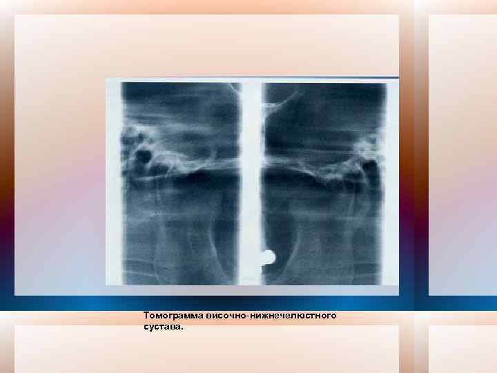 Томограмма височно-нижнечелюстного сустава. 