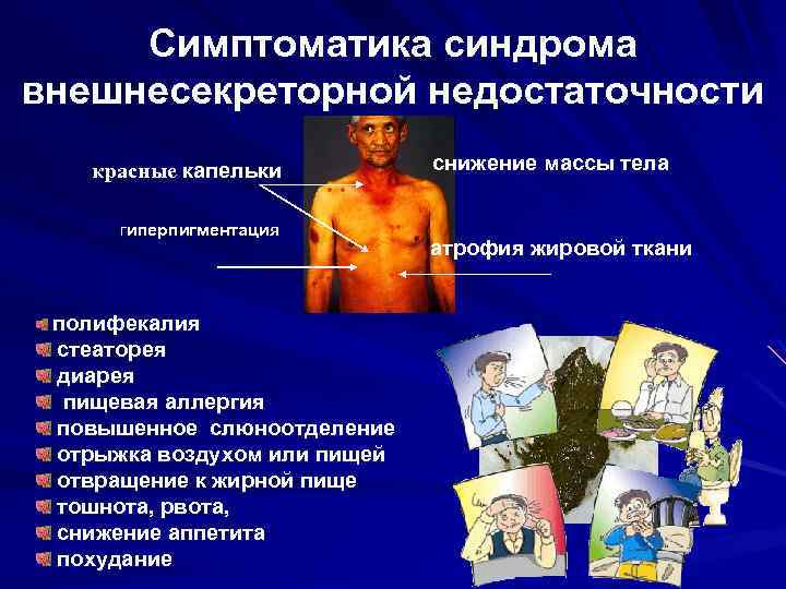 Симптоматика синдрома внешнесекреторной недостаточности красные капельки гиперпигментация снижение массы тела . . . ,