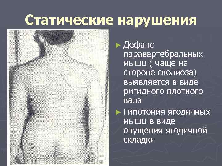 Статические нарушения ► Дефанс паравертебральных мышц ( чаще на стороне сколиоза) выявляется в виде