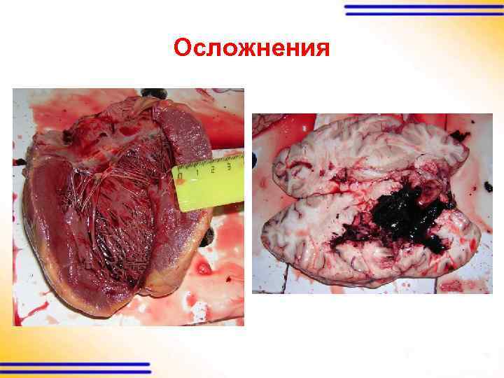 Осложнения 