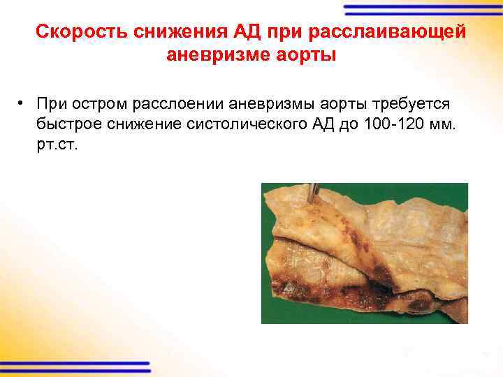 Скорость снижения АД при расслаивающей аневризме аорты • При остром расслоении аневризмы аорты требуется