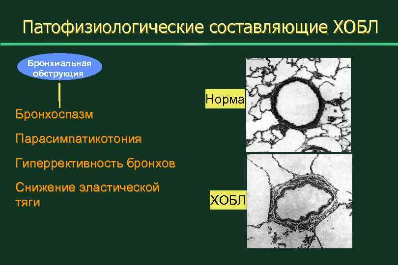 Патофизиологические составляющие ХОБЛ Бронхиальная обструкция Норма Бронхоспазм Парасимпатикотония Гиперрективность бронхов Снижение эластической тяги ХОБЛ