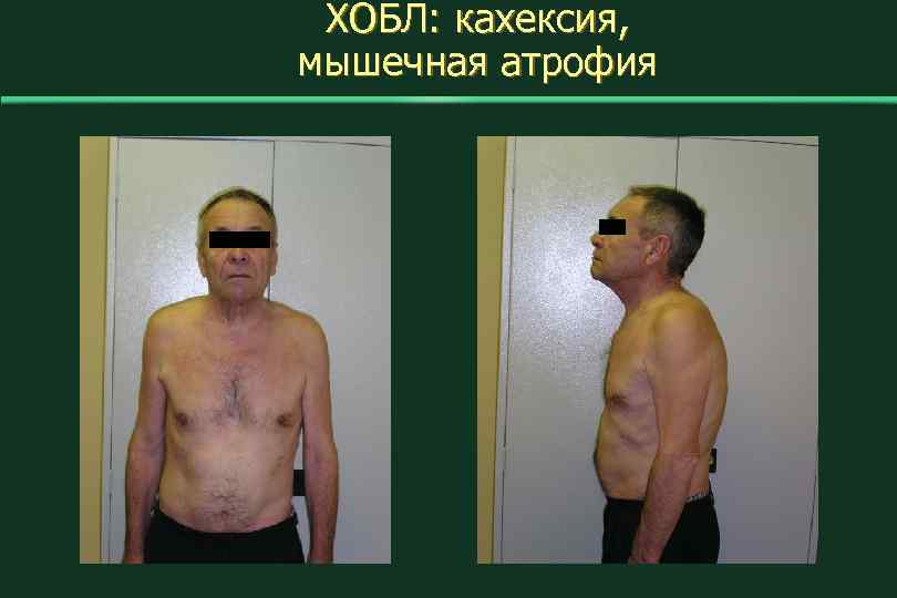 ХОБЛ: кахексия, мышечная атрофия 