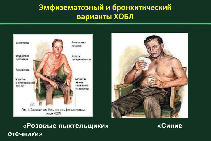 Эмфизематозный и бронхитический варианты ХОБЛ «Розовые пыхтельщики» отечники» «Синие 