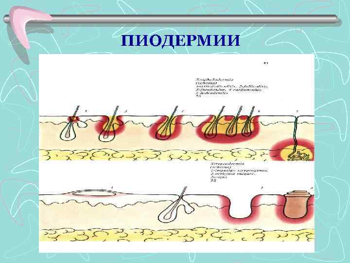 ПИОДЕРМИИ 