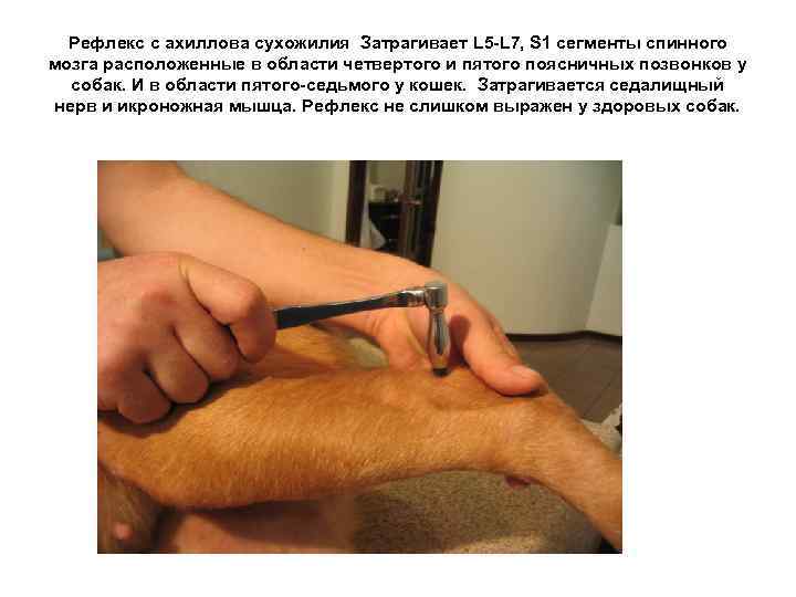 Рефлекс с ахиллова сухожилия Затрагивает L 5 -L 7, S 1 сегменты спинного мозга