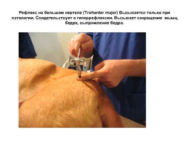 Рефлекс на большом вертеле (Trohanter major) Вызывается только при патологии. Свидетельствует о гиперрефлексии. Вызывает
