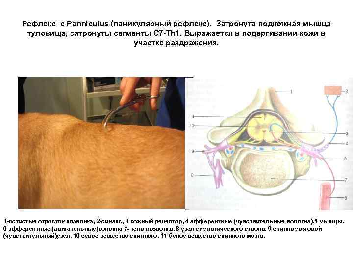 Рефлекс с Panniculus (паникулярный рефлекс). Затронута подкожная мышца туловища, затронуты сегменты С 7 -Th