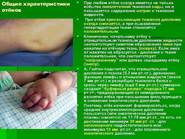 Общие характеристики отёков § § § При любом отёке всегда имеется не только избыток