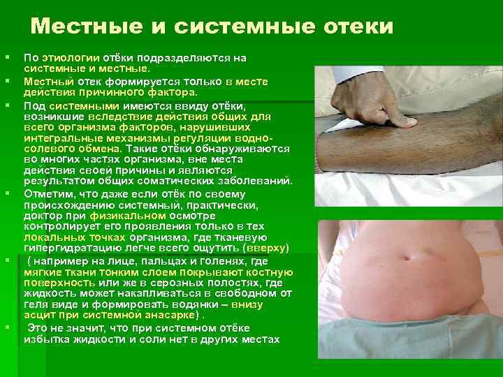 Местные и системные отеки § § § По этиологии отёки подразделяются на системные и