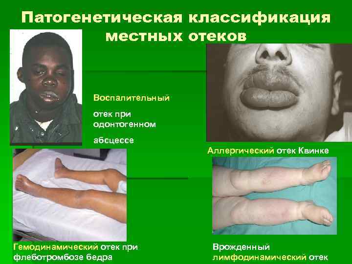 Патогенетическая классификация местных отеков Воспалительный отек при одонтогенном абсцессе Аллергический отек Квинке Гемодинамический отек