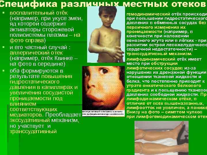 Специфика различных местных отеков § воспалительный отёк (например, при укусе змеи, яд которой содержит