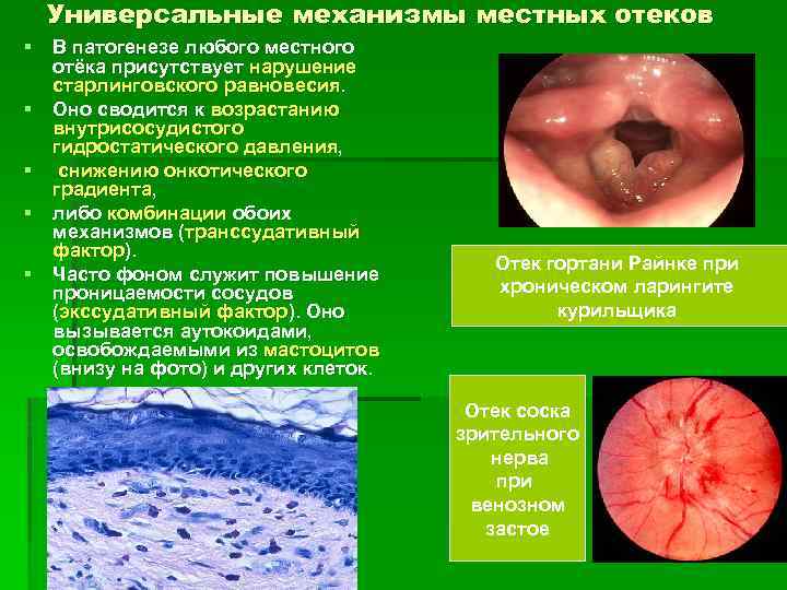 Универсальные механизмы местных отеков § В патогенезе любого местного отёка присутствует нарушение старлинговского равновесия.