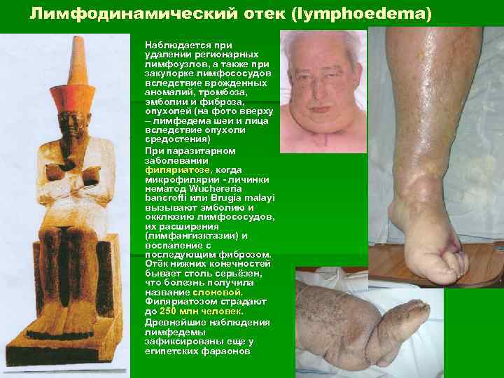 Лимфодинамический отек (lymphoedema) § § § Наблюдается при удалении регионарных лимфоузлов, а также при
