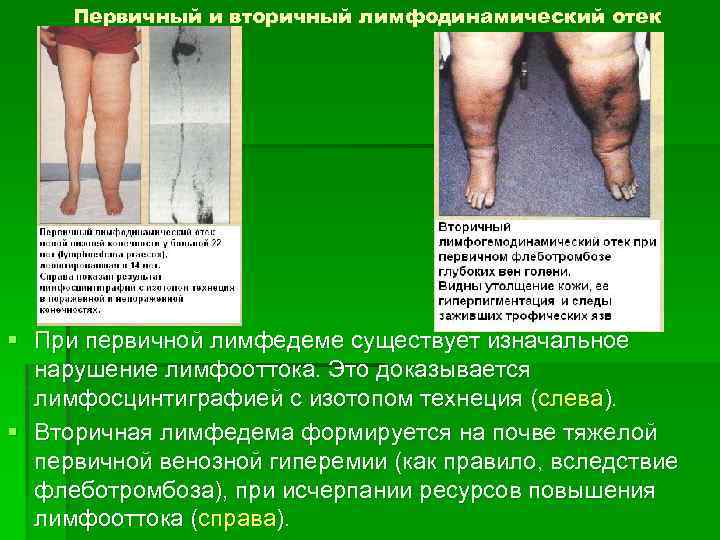 Первичный и вторичный лимфодинамический отек § При первичной лимфедеме существует изначальное нарушение лимфооттока. Это