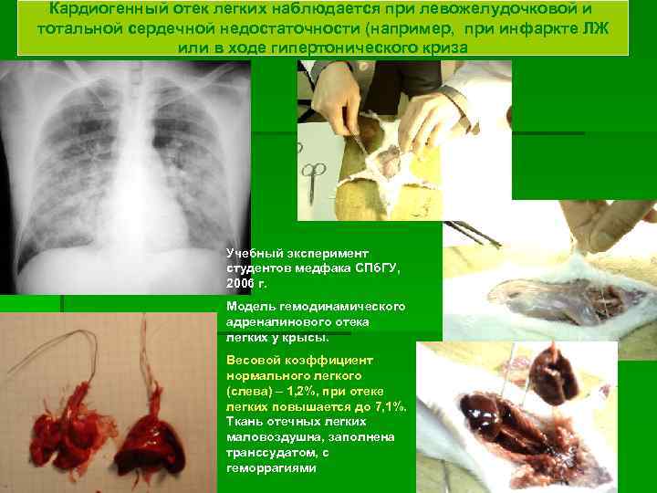 Кардиогенный отек легких наблюдается при левожелудочковой и тотальной сердечной недостаточности (например, при инфаркте ЛЖ