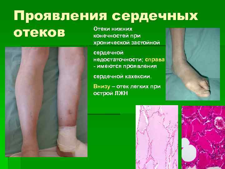 Проявления сердечных Отеки нижних отеков конечностей при хронической застойной сердечной недостаточности; справа - имеются