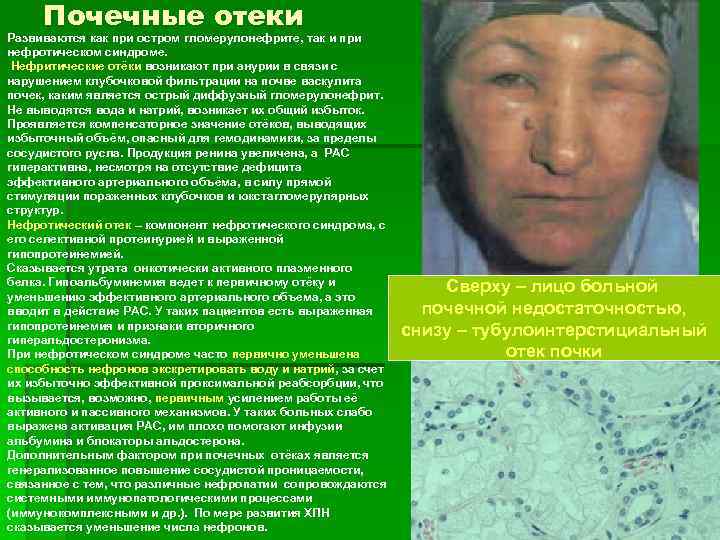 Почечные отеки Развиваются как при остром гломерулонефрите, так и при нефротическом синдроме. Нефритические отёки