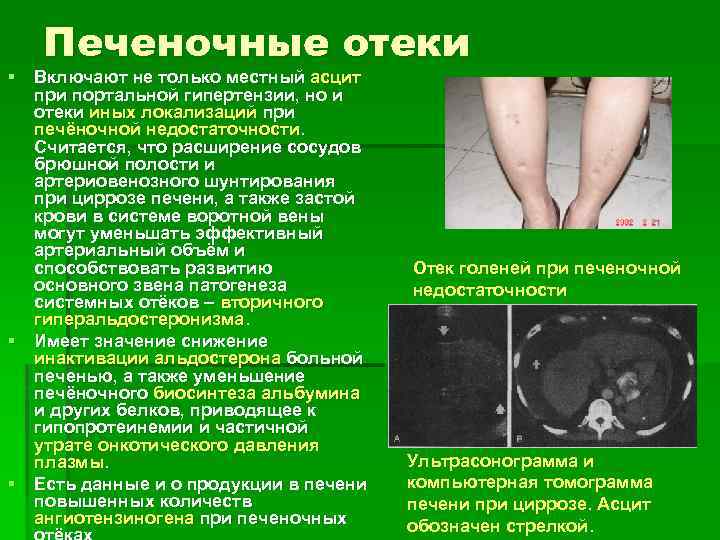 Печеночные отеки § Включают не только местный асцит при портальной гипертензии, но и отеки