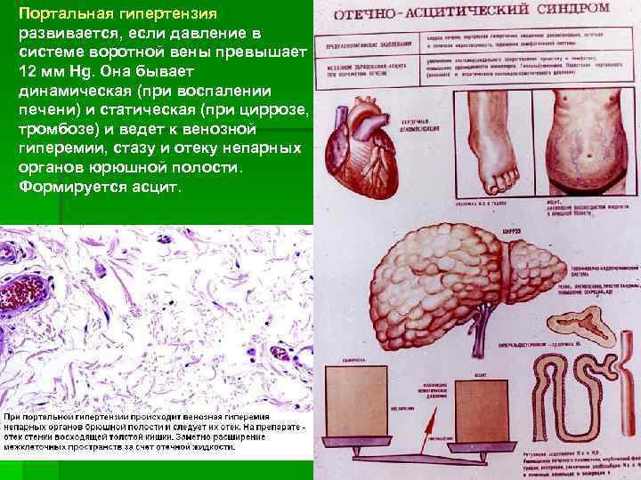 Портальная гипертензия развивается, если давление в системе воротной вены превышает 12 мм Hg. Она