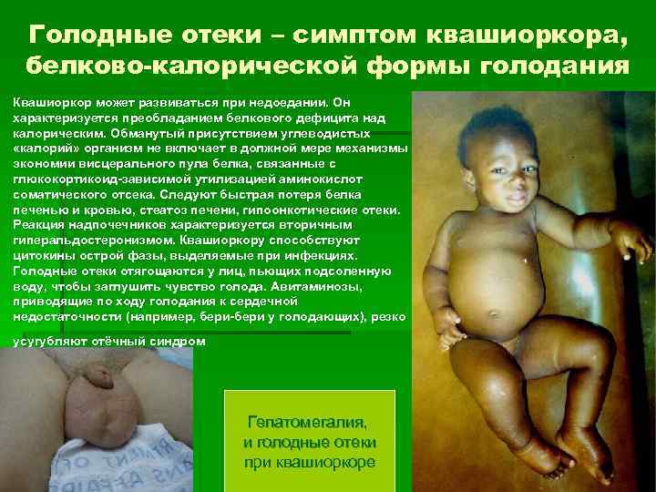 Голодные отеки – симптом квашиоркора, белково-калорической формы голодания Квашиоркор может развиваться при недоедании. Он