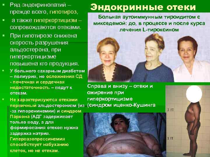 § Ряд эндокринопатий – прежде всего, гипотироз, § а также гиперкортицизм – сопровождаются отеками.