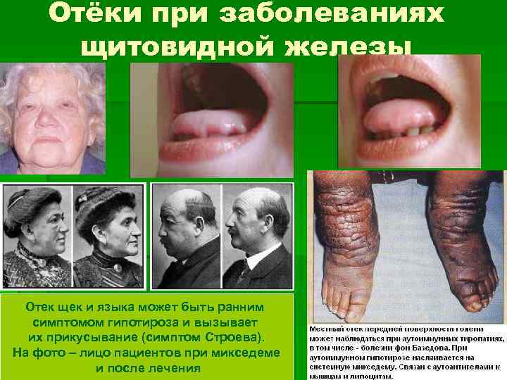 Отёки при заболеваниях щитовидной железы Отек щек и языка может быть ранним симптомом гипотироза