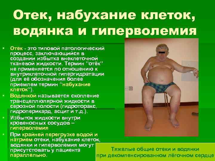 Отек, набухание клеток, водянка и гиперволемия § Отек - это типовой патологический процесс, заключающийся