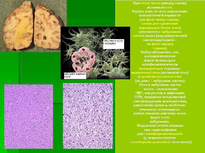 При отеке мозга (вверху слева) истинный отек белого в-ва, то есть накопление межклеточной жидкости