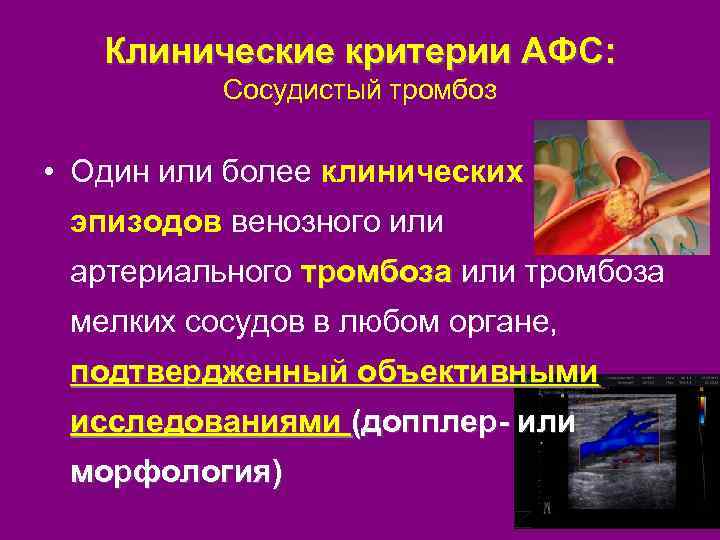 Клинические критерии АФС: Сосудистый тромбоз • Один или более клинических эпизодов венозного или артериального