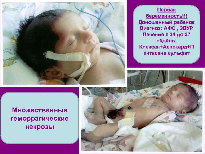 Первая беременность!!! Доношенный ребенок Диагноз: АФС , ЗВУР Лечение с 34 до 37 недель: