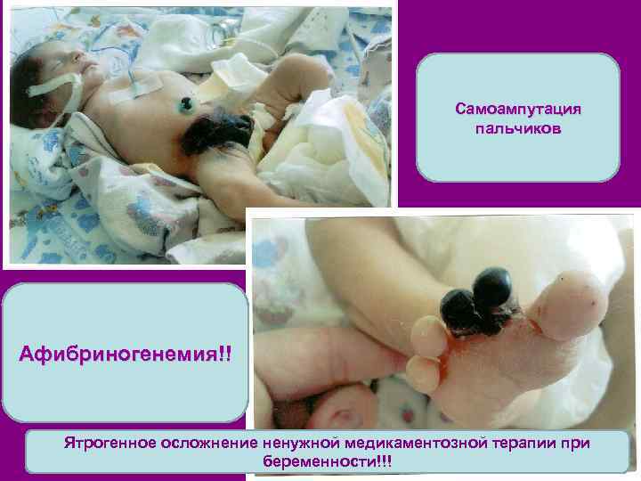 Самоампутация пальчиков Афибриногенемия!! Ятрогенное осложнение ненужной медикаментозной терапии при беременности!!! 