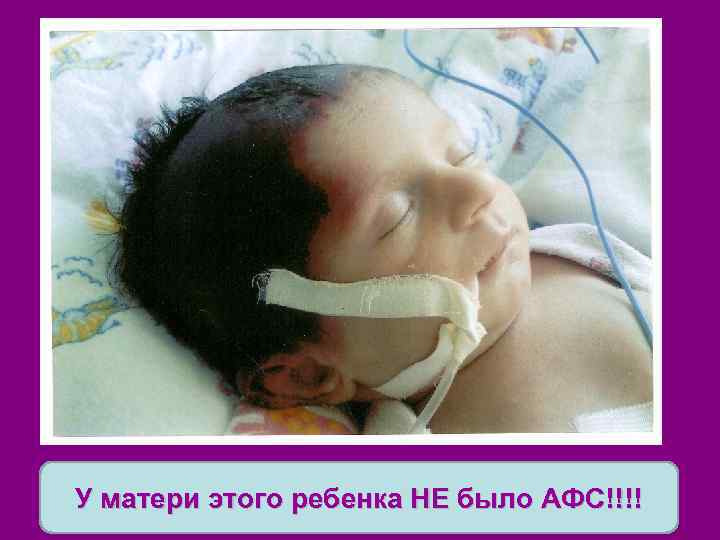 У матери этого ребенка НЕ было АФС!!!! 
