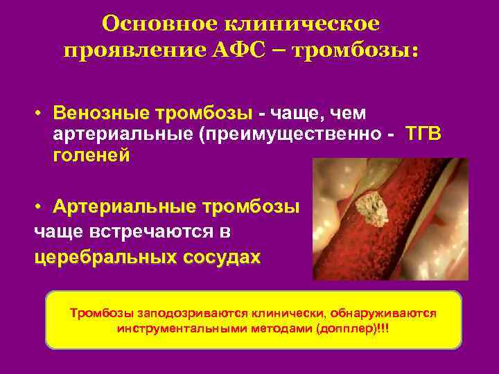 Основное клиническое проявление АФС – тромбозы: • Венозные тромбозы - чаще, чем артериальные (преимущественно