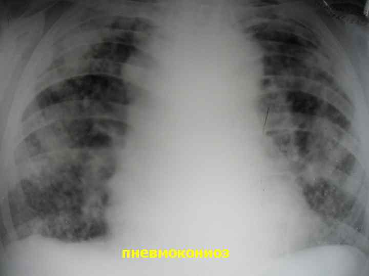 пневмокониоз 