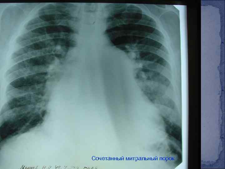 Сочетанный митральный порок 