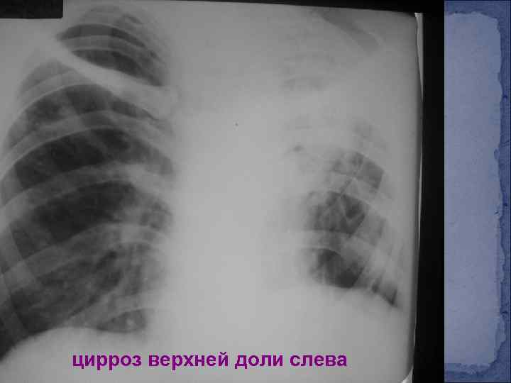 цирроз верхней доли слева 