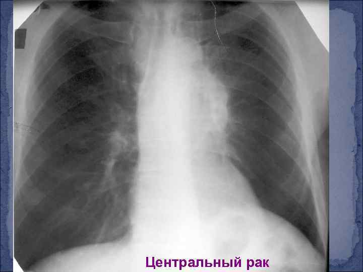 Центральный рак 