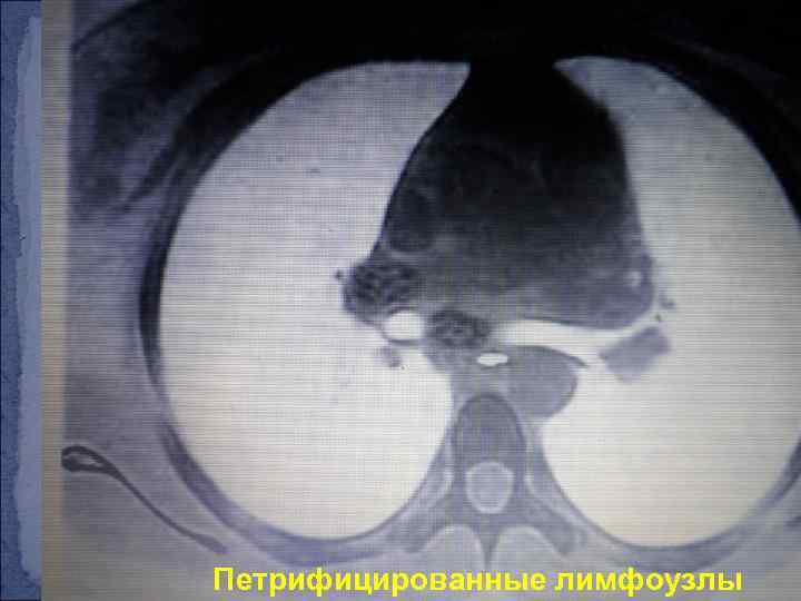 Петрифицированные лимфоузлы 
