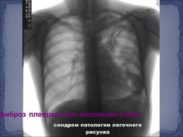 фиброз плевральные наслоения слева 