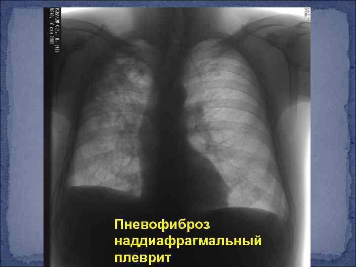 Пневофиброз наддиафрагмальный плеврит 