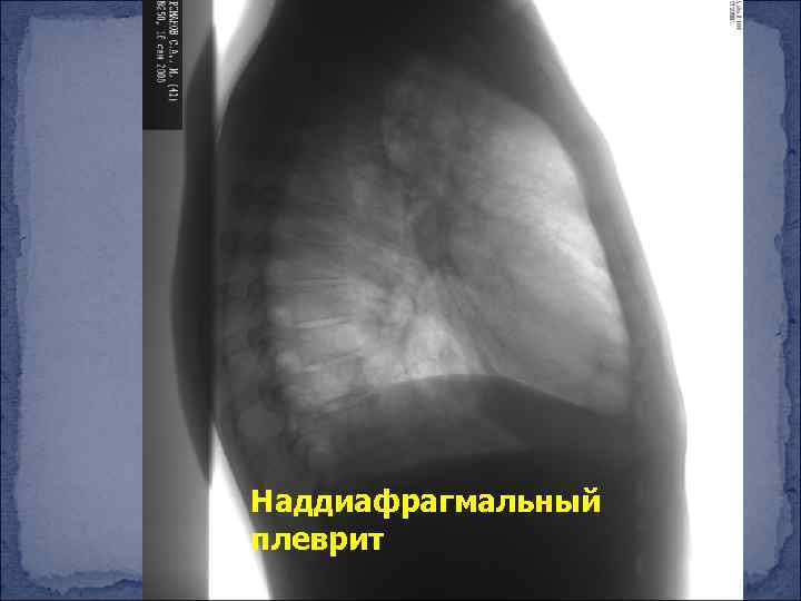Наддиафрагмальный плеврит 
