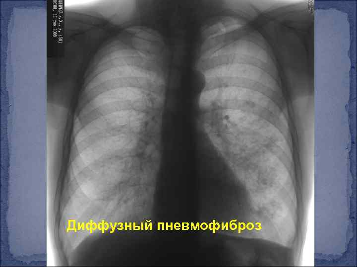 Диффузный пневмофиброз 