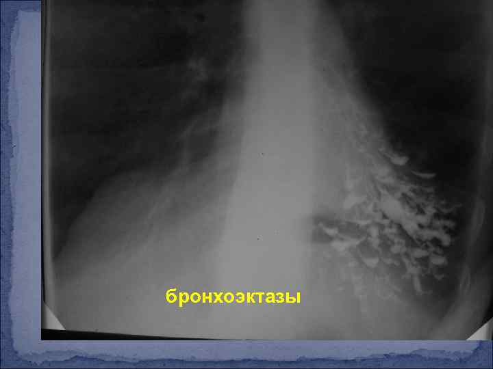 бронхоэктазы 