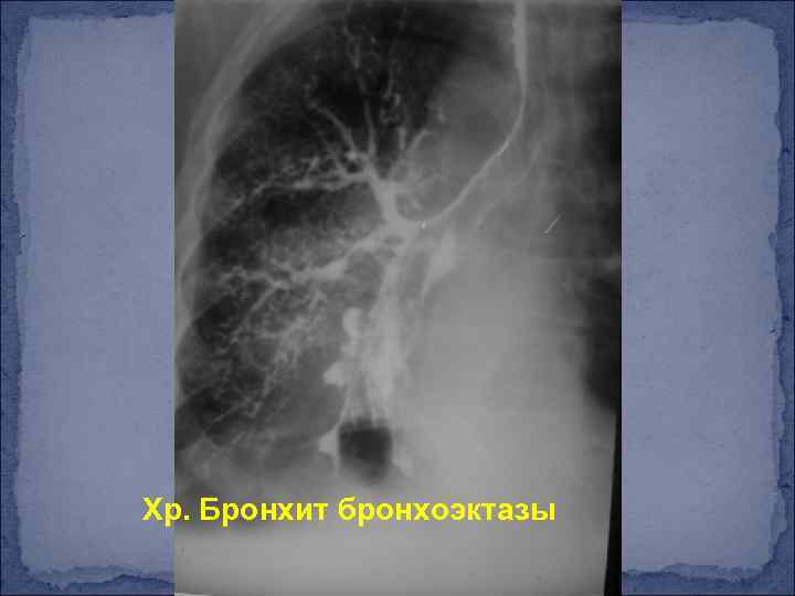 Хр. Бронхит бронхоэктазы 