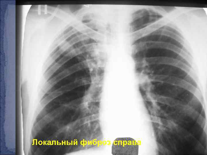 Локальный фиброз справа 