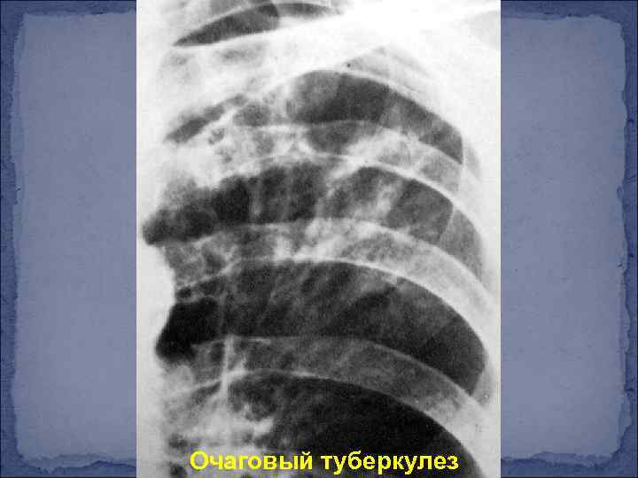 Очаговый туберкулез 
