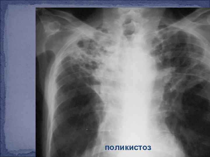 поликистоз 