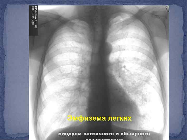 Эмфизема легких 